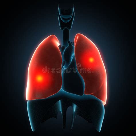 Disease Illustration of Human Lungs. Stock Illustration - Illustration of biology, graphic: 64669567