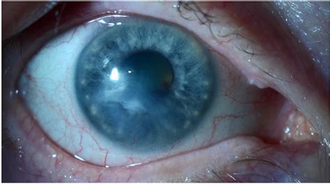 Figure 1 From Resolution Of A Neurotrophic Keratopathy Associated Hypopyon With Cenegermin