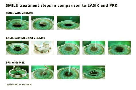 SMILE Laser Treatment Johannesburg | Laser Eye Surgery South Africa