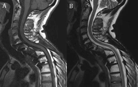 Post Operative Sagittal T1 A And T2 B Mri Sequences Download Scientific Diagram