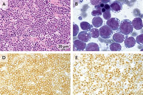 Burkitts Lymphoma Nejm Resident 360