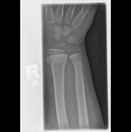 Salter Harris Type Ii Radius Fracture Radiology Case Radiopaedia Org