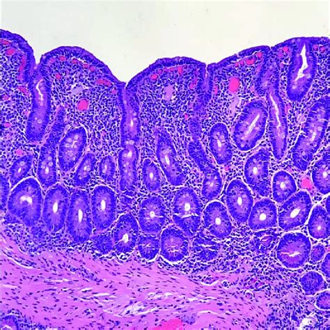 Repeat Duodenal Biopsy After Months Showing Restoration Of Normal