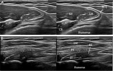 Subpectoral Biceps Tenodesis With Bicepsbutton Fixation In The Young