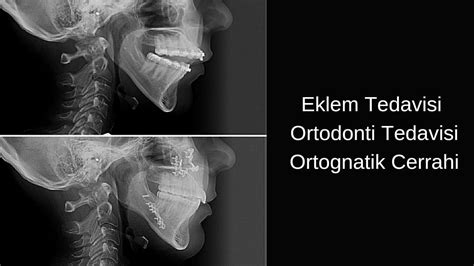 ORTODONTİK TEDAVİ SÜRECİM Çene Eklemi Problemi Ön Açık Kapanış