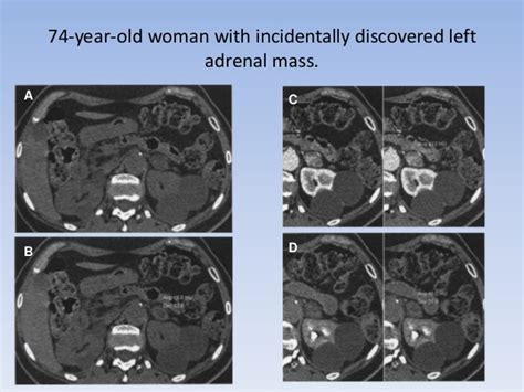 Adrenal Gland Tumors Radiology