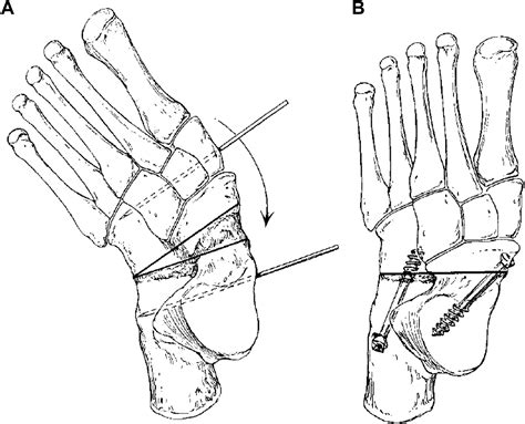 Management Of The Malunited Triple Arthrodesis Foot And Ankle Clinics