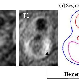 Pdf Intraplaque Hemorrhage Is Associated With Higher Structural