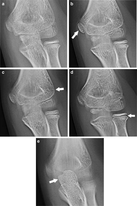 An 11-year-old boy with normal elbow anatomy on conventional... | Download Scientific Diagram