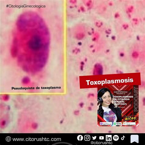 Toxoplasmosis En Citologia Cervical Pap Test