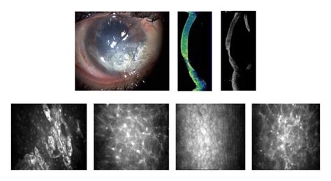 A Slit Lamp Photograph And Corresponding As Oct And Cm Images Ten