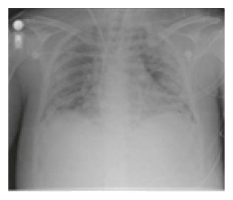 Chest X Ray Diseases A Atelectasis B Cardiomegaly C