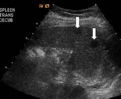 Spleen Ultrasound Flashcards Quizlet