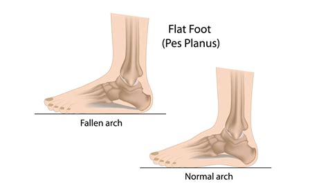 Flat Feet in Children - Lifescan Physio