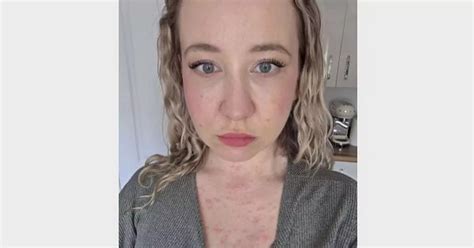 Mum Claims Dirty Hot Tub On Birthday Getaway Caused Absolutely Wild