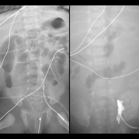 Premature newborn with new left femoral vein catheter that will not ...