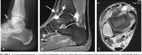 Figure 6 From Imaging Of Impingement Lesions In The Ankle Semantic