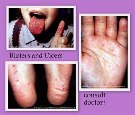 Rawatan Semulajadi Untuk HFMD Hand Foot Mouth Disease Butik GebuGebu