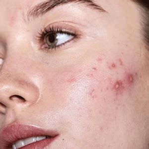 Acne Na Gravidez Como Identificar E Tratar As Inflama Es Durante A