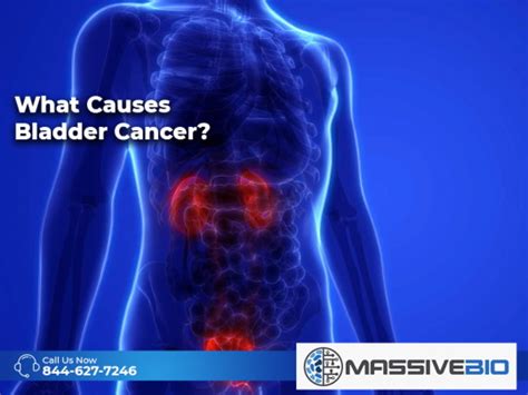 What Causes Bladder Cancer? - Risk Factors - Massive Bio