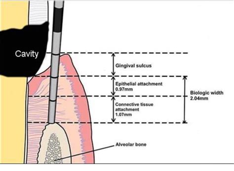 Figure 1 From The Localization Subgingival Margins Of Cavity A New