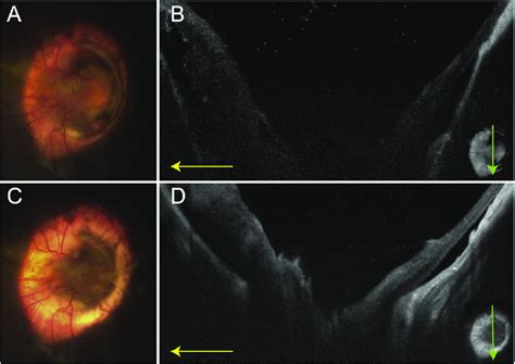 Fundus Photography And Swept Source Optical Coherence Tomography