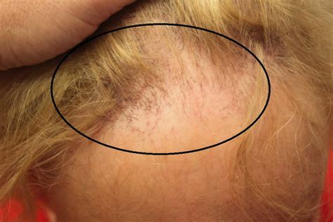 Frontal Fibrosing Alopecia Causes Symptoms Diagnosis Treatment