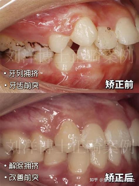 重庆牙齿矫正｜重庆正畸龅牙影响颜值矫正收获满意笑容 知乎