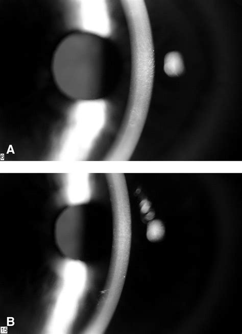 Amantadine Associated Corneal Edema Ophthalmology