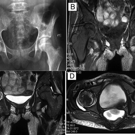 X Ray Pelvis Shows Well Defined Sclerotic Focus In Subchondral Aspect