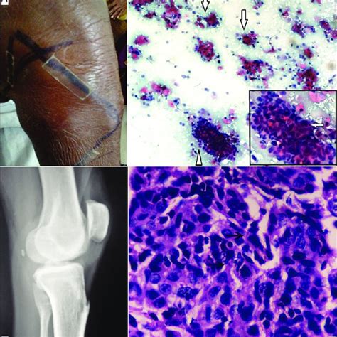 (a) Clinical photograph of the swelling (b) X‑ray of knee joint ...