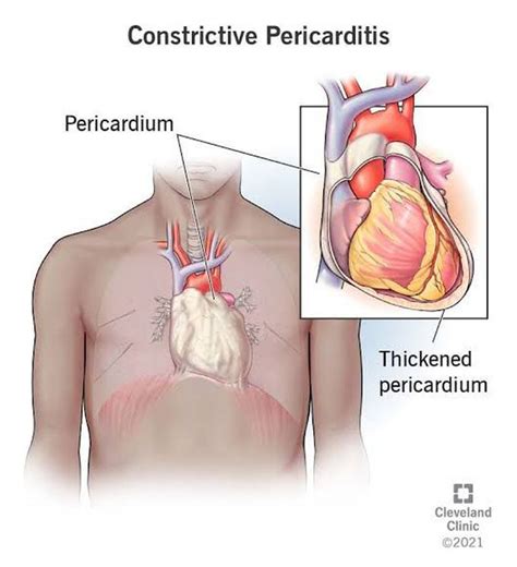 Constructive Pericarditis MEDizzy