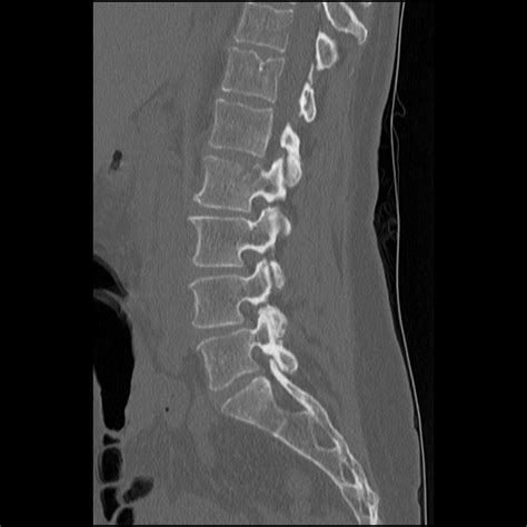 Schmorl Node Acute Image Radiopaedia Org