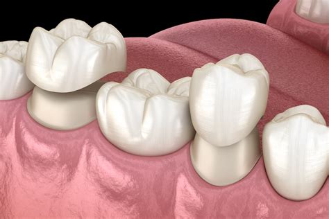 Are Cerec Crowns Better Than Porcelain Dental Blog Mckinney Dental