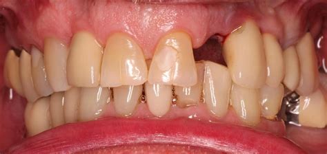 Dr. Dane Uhl, DMD | Smile Gallery | Single Implant and Crown