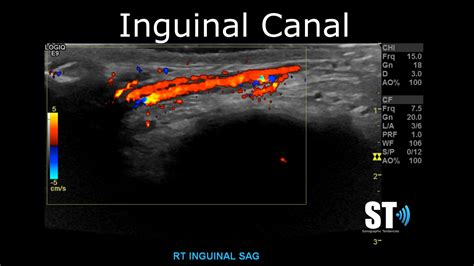 Testicular Scrotal Doppler Protocol Sonographic Tendencies