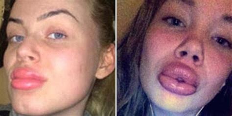 Elite Daily On Twitter Girls Use A Water Bottle To Get Kylie Jenner Lips And Fail Miserably