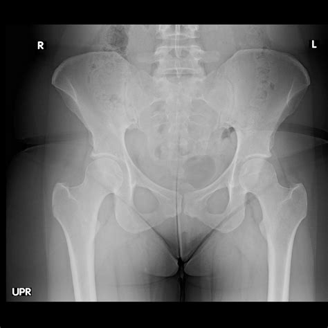 OrthoDx: Labral Tear of the Hip - Clinical Advisor