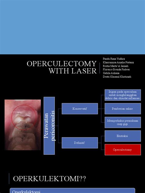 Operculectomy With Laser Pdf