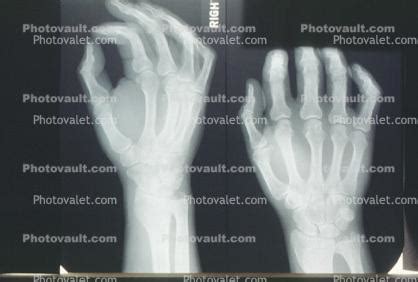 hand, fingers, knuckles, X-Ray, Anatomy, Skeletons, Photo