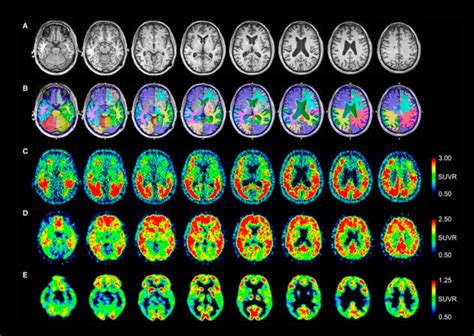 Project In Vivo Neuroimaging Biomarker Panel For Traumatic Brain