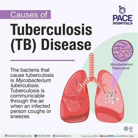 Tuberculosis Symptoms Types Causes Risk Factors And Prevention