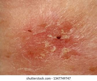 Case Squamous Cell Carcinoma Situ Bowens Foto De Stock 1347749759