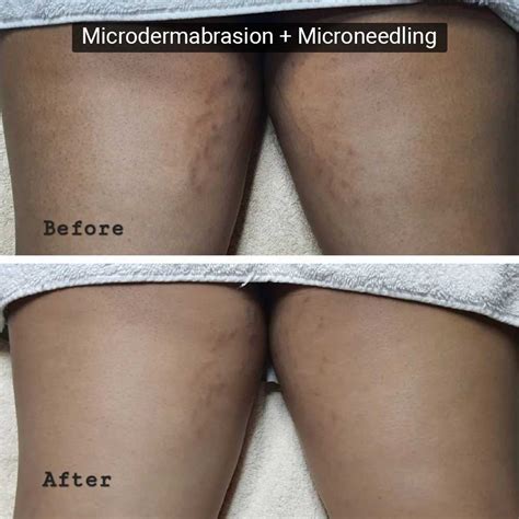 Microdermabrasion For Stretch Marks How Does It Work