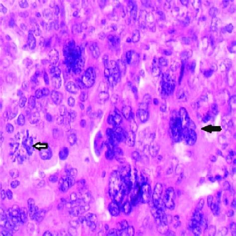 Pleomorphic Multinucleated Giant Cell Distributed Amidst Mononuclear