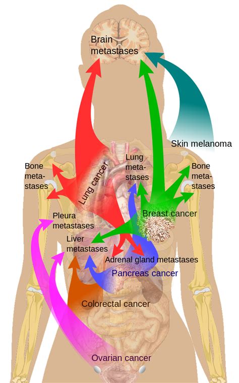 Bone metastasis - wikidoc