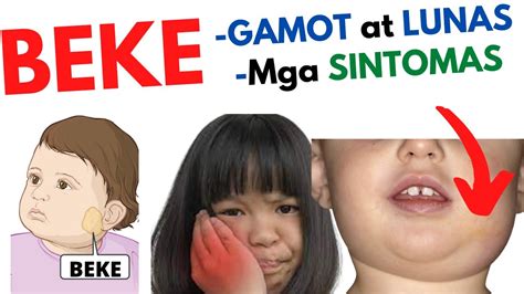 Gamot At Lunas Sa Beke At Mga Sintomas Beke O Mumps Sa Bata Matanda Youtube