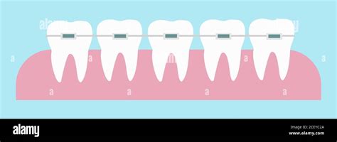 Teeth With Orthodontic Dental Braces Correction On The Gums Vector