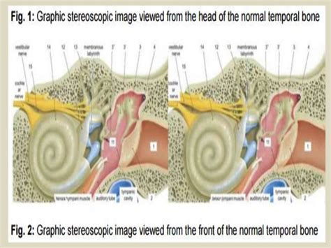 Presentation1.pptx, ct high resolution anatomy of the petrous bone.