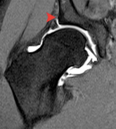 Hip Labral Tear Cartilage Tear — Huang Orthopaedics